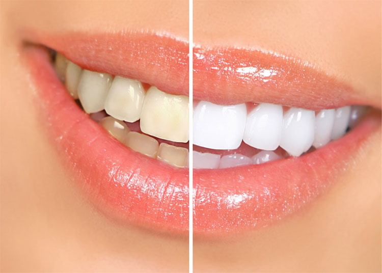 sonrisa blanqueamiento dental